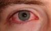 Синдром сухих глаз. Рекомендации больным