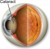 Лечение катаракты без боли